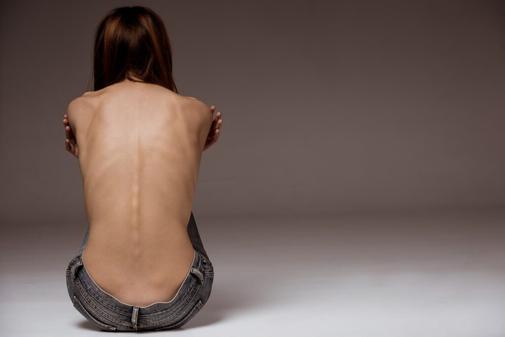 Kobieta z anoreksją